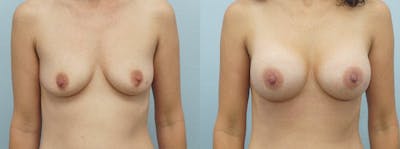 Breast Augmentation Before & After Gallery - Patient 48821290 - Image 1