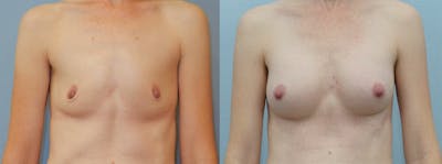 Breast Augmentation Before & After Gallery - Patient 48821293 - Image 1