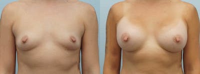 Breast Augmentation Before & After Gallery - Patient 48821298 - Image 1