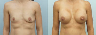 Breast Augmentation Before & After Gallery - Patient 48821300 - Image 1