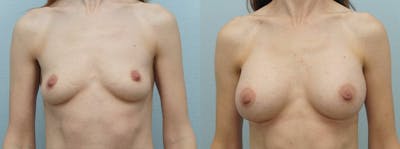 Breast Augmentation Before & After Gallery - Patient 48821303 - Image 1