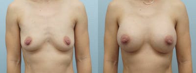 Breast Augmentation Before & After Gallery - Patient 48821305 - Image 1