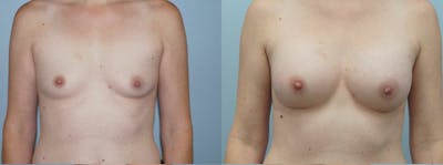 Breast Augmentation Before & After Gallery - Patient 48821312 - Image 1
