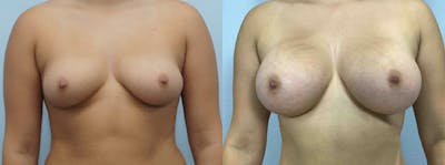 Breast Augmentation Before & After Gallery - Patient 48821314 - Image 1