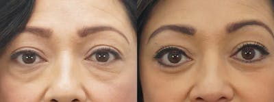Brow Lift Before & After Gallery - Patient 48938965 - Image 1