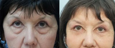 Brow Lift Before & After Gallery - Patient 48938984 - Image 1