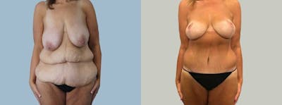 Mommy Makeover Before & After Gallery - Patient 49139729 - Image 1