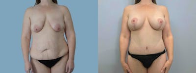 Mommy Makeover Before & After Gallery - Patient 49139734 - Image 1
