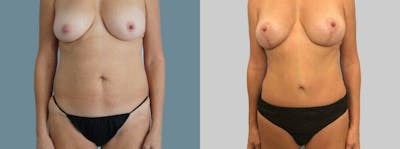 Mommy Makeover Before & After Gallery - Patient 49139750 - Image 1