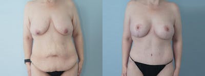 Mommy Makeover Before & After Gallery - Patient 49139758 - Image 1