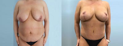 Mommy Makeover Before & After Gallery - Patient 49139795 - Image 1