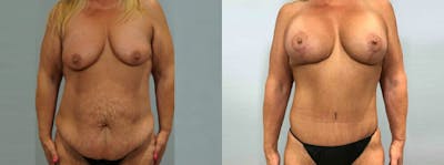 Mommy Makeover Before & After Gallery - Patient 49139803 - Image 1