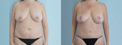 Mommy Makeover Before & After Gallery - Patient 49139806 - Image 1