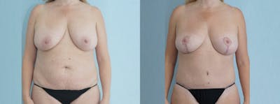 Mommy Makeover Before & After Gallery - Patient 49139806 - Image 1