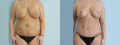 Mommy Makeover Before & After Gallery - Patient 49139809 - Image 1