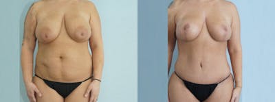Mommy Makeover Before & After Gallery - Patient 49139809 - Image 1