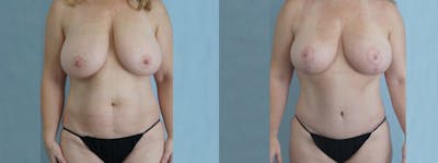 Mommy Makeover Before & After Gallery - Patient 49139816 - Image 1