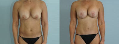 Mommy Makeover Before & After Gallery - Patient 49139818 - Image 1
