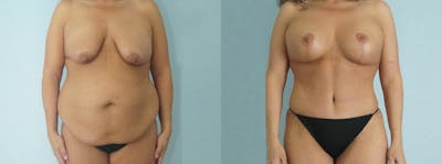 Mommy Makeover Before & After Gallery - Patient 49139819 - Image 1