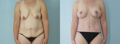 Mommy Makeover Before & After Gallery - Patient 49139830 - Image 1