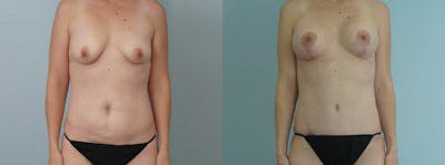 Mommy Makeover Before & After Gallery - Patient 49139836 - Image 1