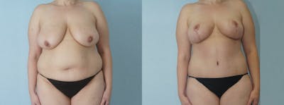 Mommy Makeover Before & After Gallery - Patient 49139838 - Image 1