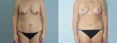Mommy Makeover Before & After Gallery - Patient 49139849 - Image 1