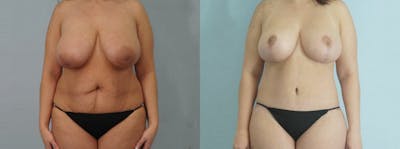 Mommy Makeover Before & After Gallery - Patient 49139857 - Image 1