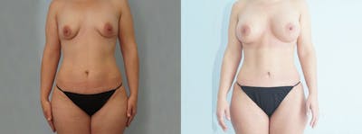 Mommy Makeover Before & After Gallery - Patient 49139859 - Image 1