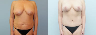 Mommy Makeover Before & After Gallery - Patient 49139860 - Image 1