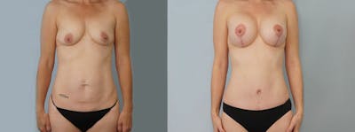 Mommy Makeover Before & After Gallery - Patient 49139863 - Image 1