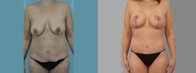 Mommy Makeover Before & After Gallery - Patient 49139866 - Image 1