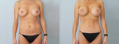 Mommy Makeover Before & After Gallery - Patient 49139868 - Image 1