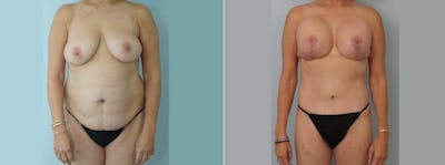 Mommy Makeover Before & After Gallery - Patient 49139869 - Image 1