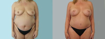Mommy Makeover Before & After Gallery - Patient 49139874 - Image 1