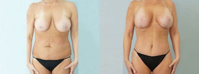 Mommy Makeover Before & After Gallery - Patient 49139876 - Image 1