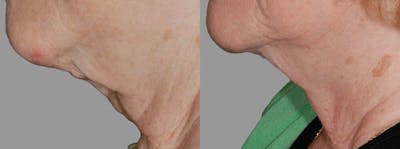 Skin Tightening and Wrinkle Reduction Before & After Gallery - Patient 49140173 - Image 1