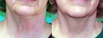 Skin Tightening and Wrinkle Reduction Before & After Gallery - Patient 49140174 - Image 1