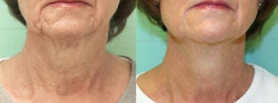 Skin Tightening and Wrinkle Reduction Before & After Gallery - Patient 49140178 - Image 1