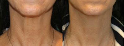 Skin Tightening and Wrinkle Reduction Before & After Gallery - Patient 49140179 - Image 1