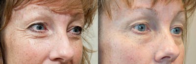 Skin Tightening and Wrinkle Reduction Before & After Gallery - Patient 49140183 - Image 1
