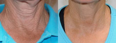 Skin Tightening and Wrinkle Reduction Before & After Gallery - Patient 53599809 - Image 1