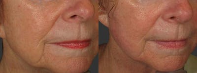 Skin Tightening and Wrinkle Reduction Before & After Gallery - Patient 49140186 - Image 1