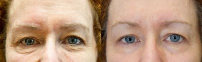 Skin Tightening and Wrinkle Reduction Before & After Gallery - Patient 49140190 - Image 1