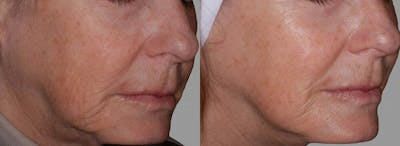 Skin Tightening and Wrinkle Reduction Before & After Gallery - Patient 49140196 - Image 1