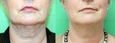 Skin Tightening and Wrinkle Reduction Before & After Gallery - Patient 49140199 - Image 1