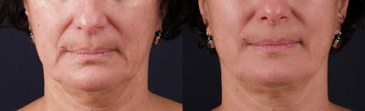 Skin Tightening and Wrinkle Reduction Before & After Gallery - Patient 49140202 - Image 1
