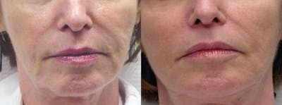 Skin Tightening and Wrinkle Reduction Before & After Gallery - Patient 49140203 - Image 1