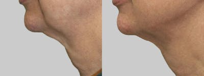 Skin Tightening and Wrinkle Reduction Before & After Gallery - Patient 49140205 - Image 1
