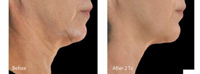 Skin Tightening and Wrinkle Reduction Before & After Gallery - Patient 49140209 - Image 1